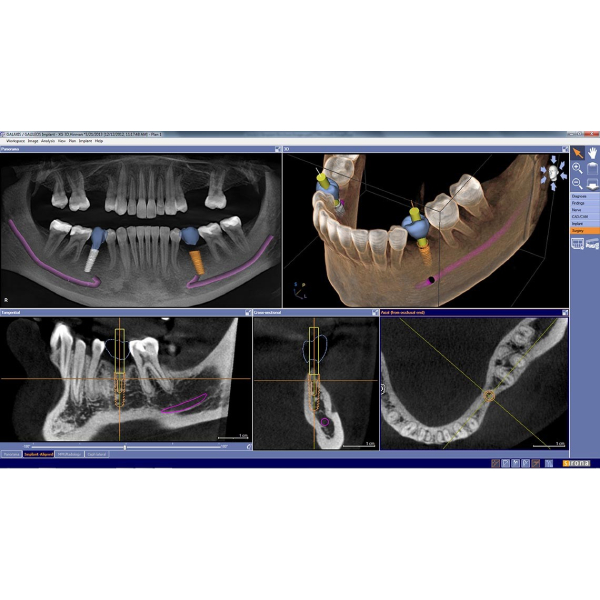 advantages-and-disadvantages-of-digital-implants
